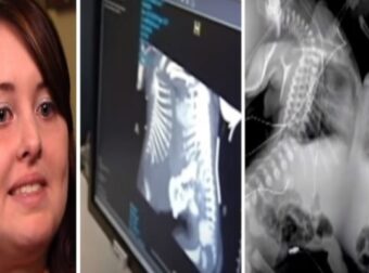 27χρονη έγκυος πήγε να κάνει υπερηχογράφημα – Όταν το είδαν οι γιατροί πάγωσαν και της είπαν να το ρίξει (Video) – Funny-Περίεργα