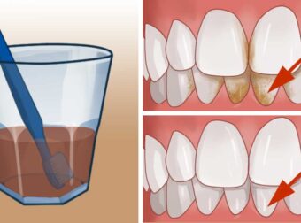 3 Θαυματουργές σπιτικές Συνταγές για να αφαιρέσετε την Πέτρα από τα Δόντια σας με Φυσικό τρόπο!